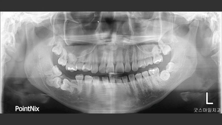 Case report of kissing molars impaction
she prese…