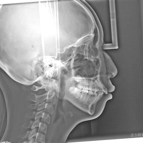 Change of profile by total arch intrusion and retr…