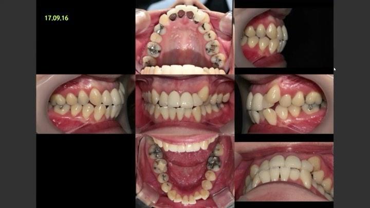 Camouflage treatment of skeletal Class II with hyp…