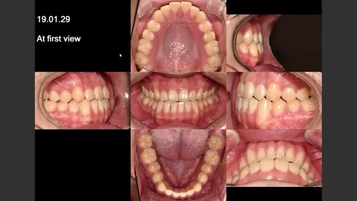 Camouflage treatment of skeletal Class III dental …