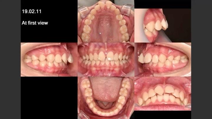 Treatment of dental Class II with large overjet an…