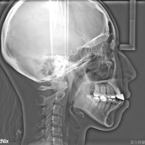 Change of profile by total arch intrusion and retr…