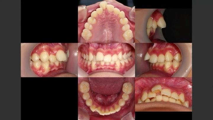 Camouflage treatment of skeletal Class II, Dental …