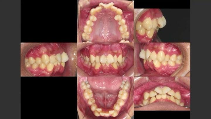 Canine and lateral incisor substitution of each fo…