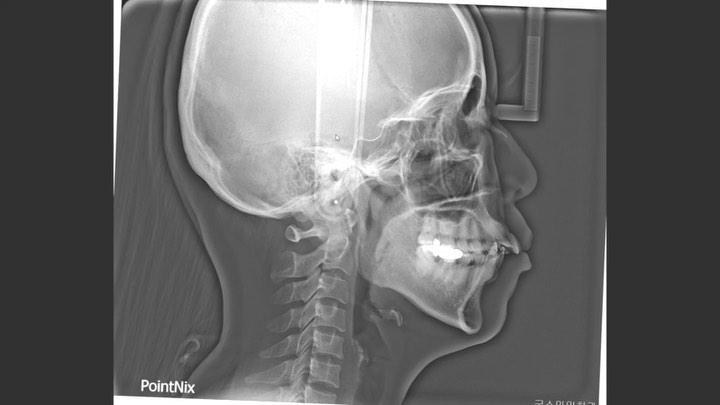 Treatment of gummy smile
1. DBS .022” Mbt Clippy c…
