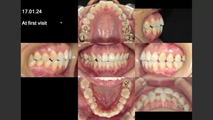Camouflage treatment of skeletal Class II, dental …