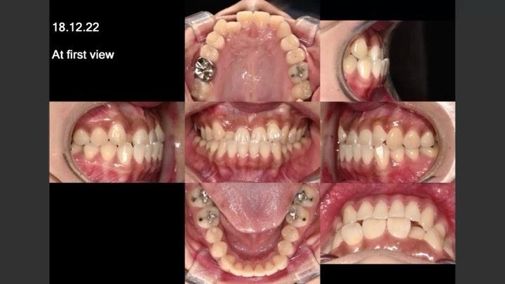 Camouflage treatment of skeletal Class III with ma…