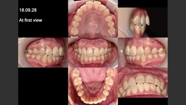 Camouflage treatment of lip protrusion due to VME …