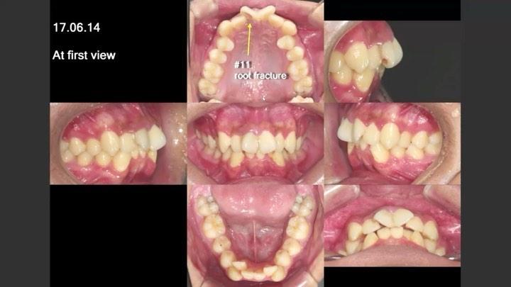 Camouflage treatment of skeletal Class II with #11…