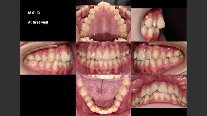 Camouflage treatment of skeletal Class I dental Cl…