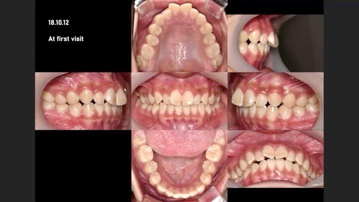 Total arch retraction of upper whole arch to treat…