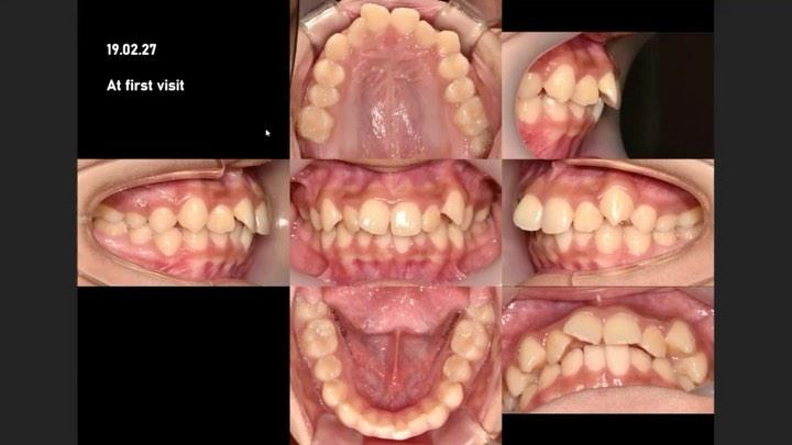 Treatment of Class II malocclusion using upper tot…