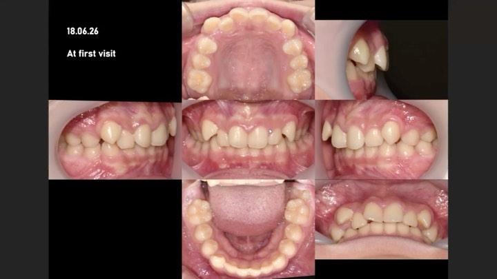 Total distalization of the
maxillary arch in a pat…
