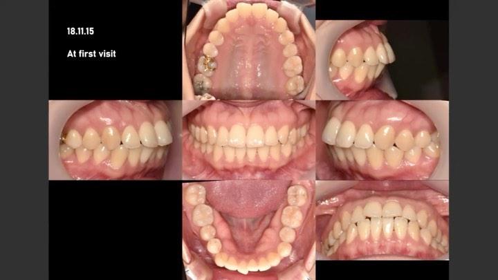 Treatment of mild to moderate lip protrusion by us…