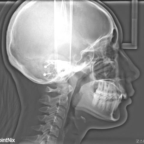 Total arch movements to correct Class II with deep…