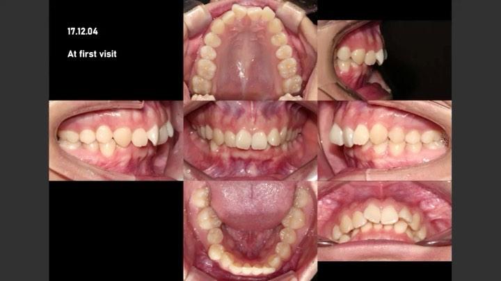 Treatment of Class II patient with severe deep bit…
