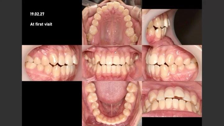 Treatment of skeletal Class III with anterior open…