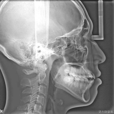 Treatment of skeletal Class III with anterior open…