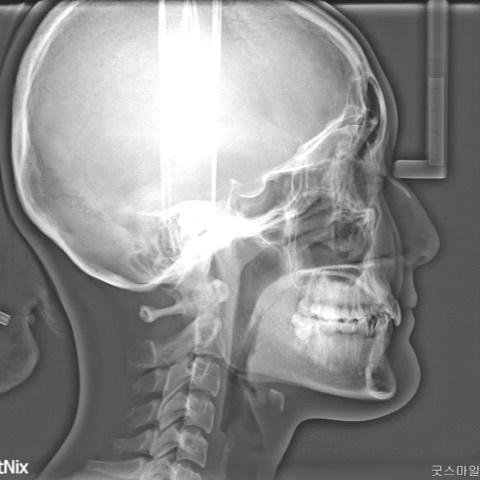 Upper total arch retraction
#blackshaqgoodsmile …