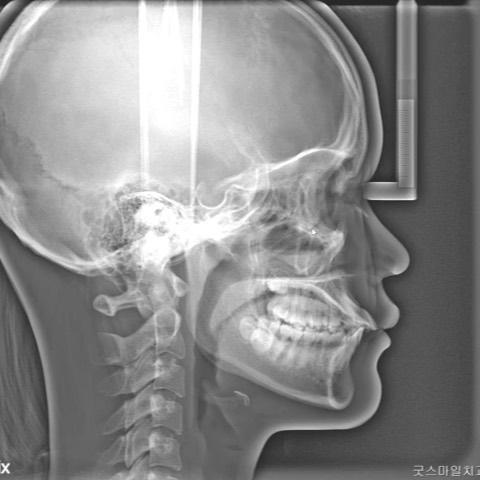 Correction of reverse smile arc with MARE and uppe…