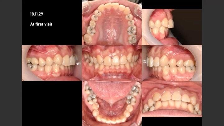 Canine substitution and upper molar protraction to…