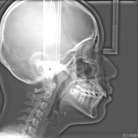 Upper total arch retraction to solve slight lip pr…