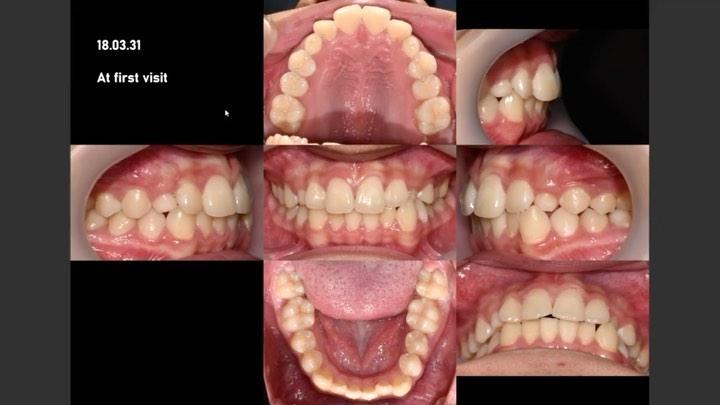Treatment of complete transposition between both u…