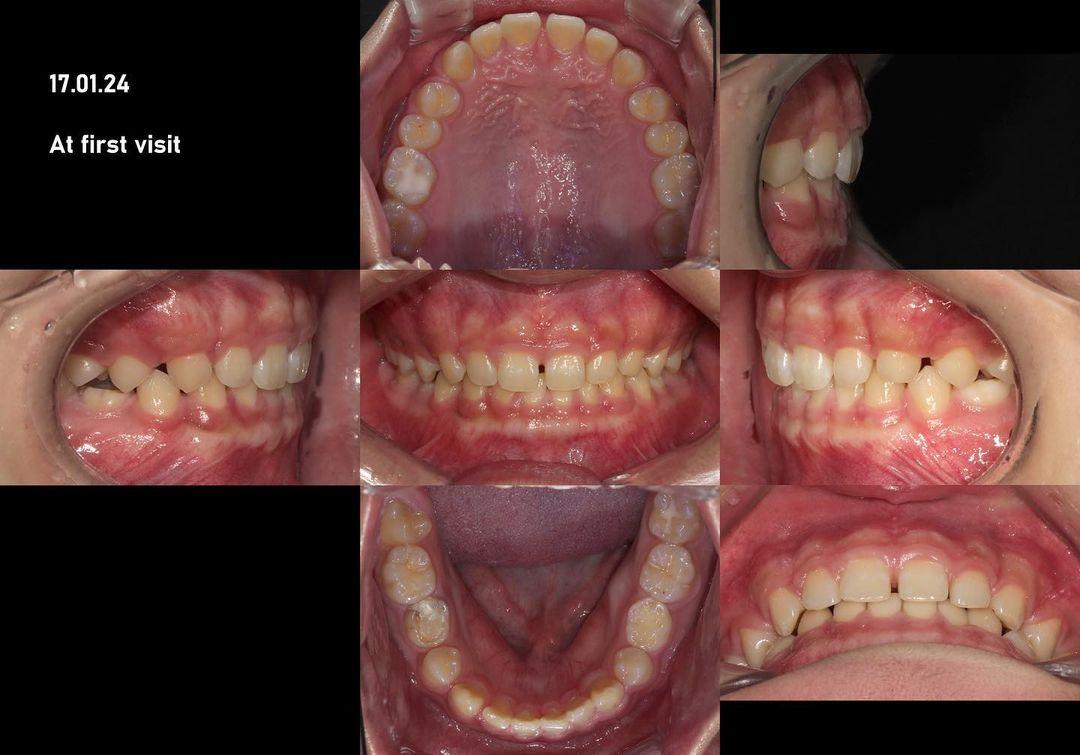 What’s your take on this case?
1. Skeletal Class I…