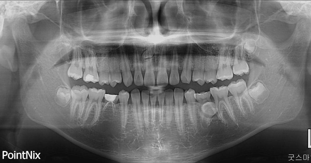 How about that!!
Asymmetrical lower mandibular mo…