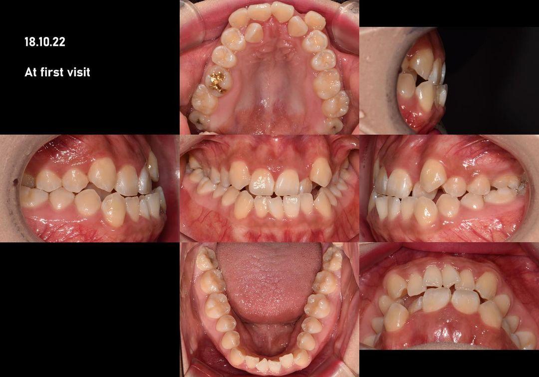 Treatment of skeletal Class III with mandibular ex…