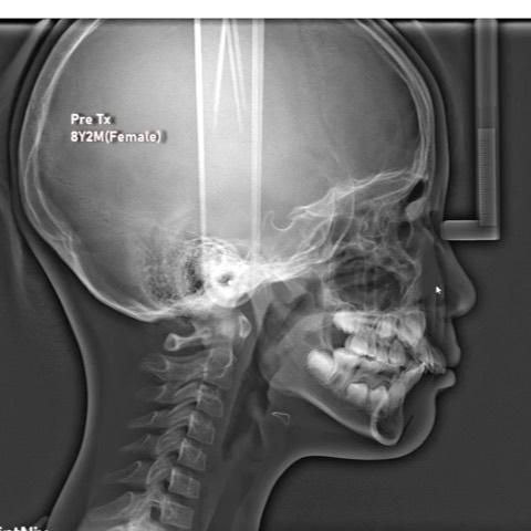 2 phase treatment of skeletal Class II with mandib…