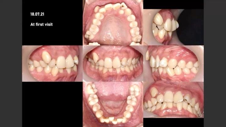 Camouflage treatment of skeletal Class II, cleft l…