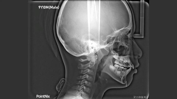 Two phases’ treatment of skeletal Class II, dental…