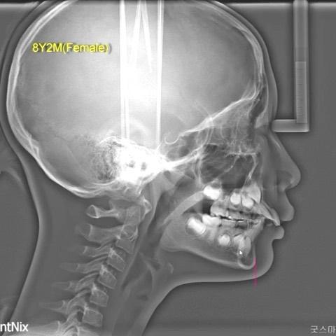 Phase 1- Growth modification of skeletal Class II …