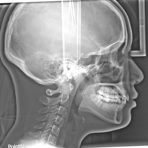 Treatment of dental Class II with severe anterior …