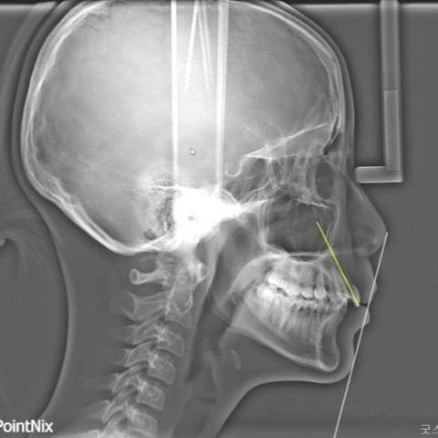 Camouflage treatment of skeletal Class II, dental …