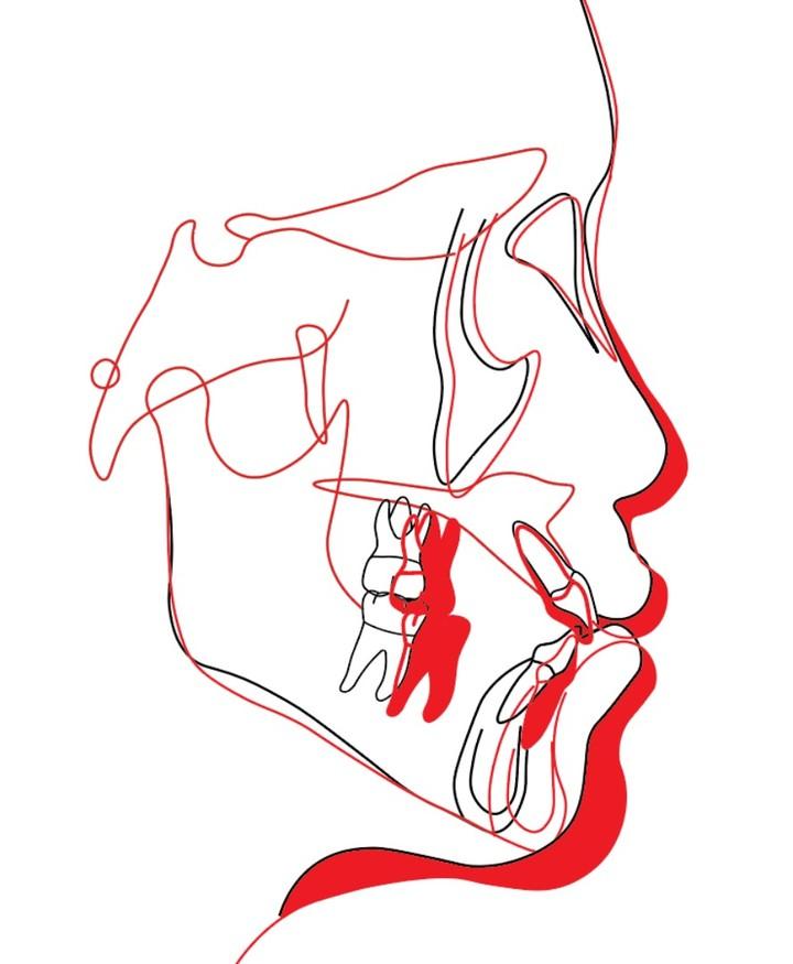 Treatment of skeletal Class III with slight mandib…