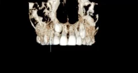 impacted canine
#blackshaqgoodsmile #impactedcanin…