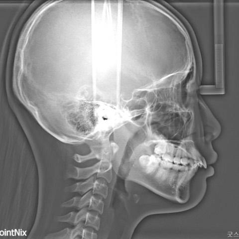 Treatment of Class II with large overjet and overb…