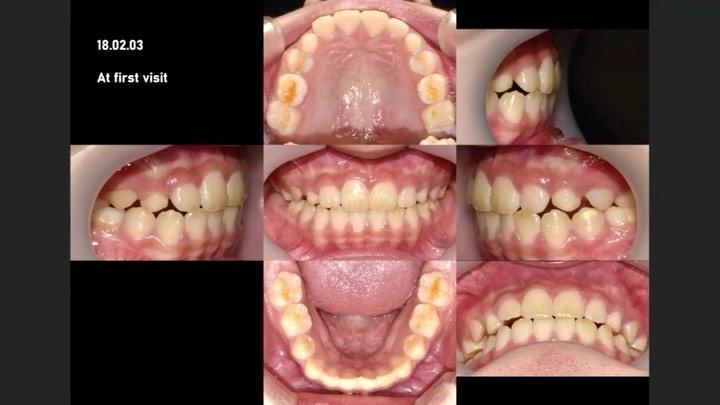 Treatment of Class II patient with upper right imp…