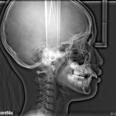 treatment progress
1. Class II activator+headgear
…