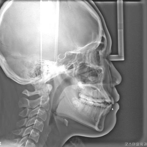 Treatment of skeletal Class III with upper moderat…