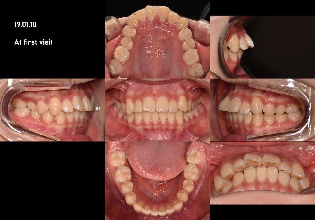 How could I treat this patient who had reverse smi…