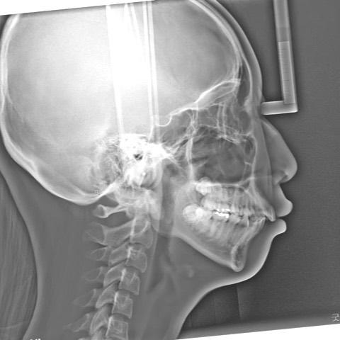 orthognathic surgery-like orthodontic treatment
…