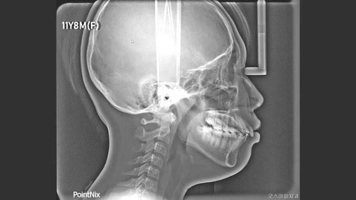 Treatment of skeletal Class II, dental Class II wi…