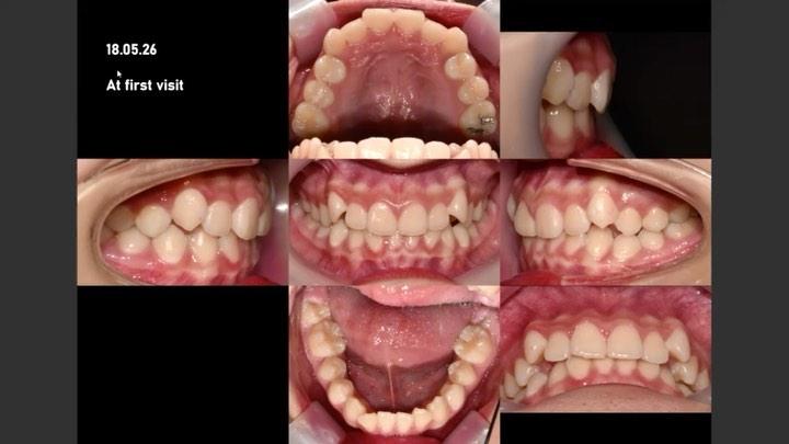 Camouflage treatment of skeletal Class III, dental…