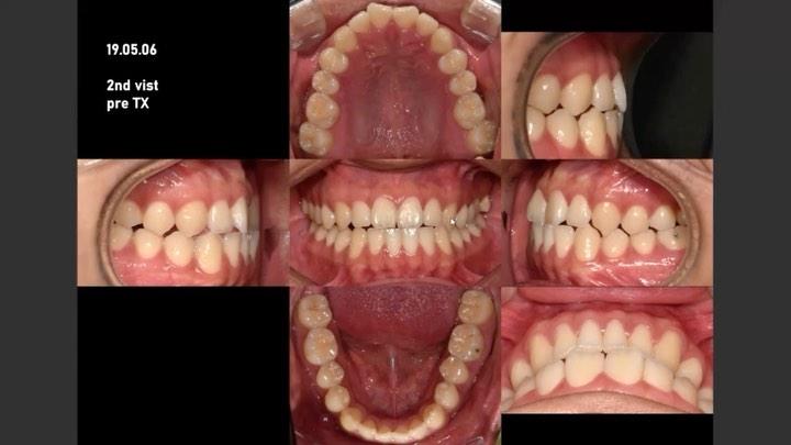 Camouflage treatment of skeletal Class III with ma…