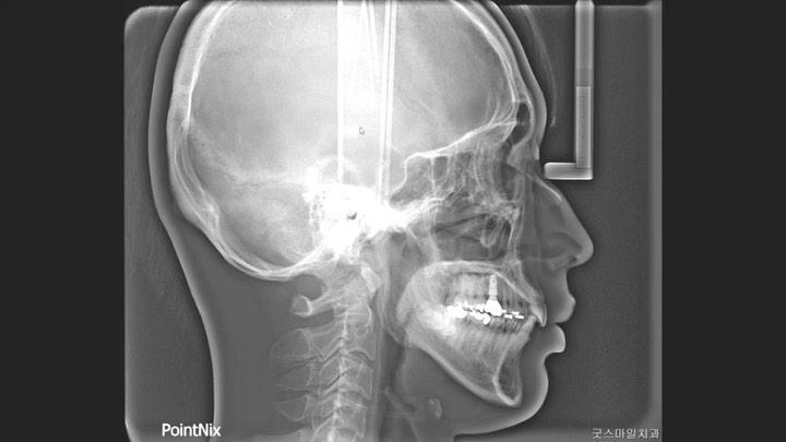 Space closure after extraction of implant and yawi…