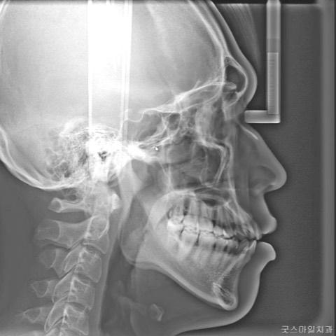 Treatment of lip protrusion with skeletal Class II…