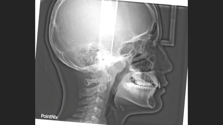 Treatment of dental Class II with deep overbite an…